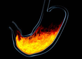 Don’t ignore symptoms of acid reflux